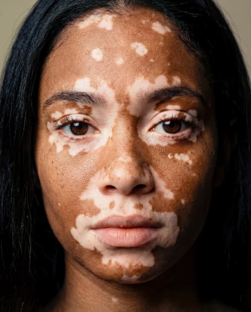 White Spots on Skin: Causes, Symptoms, and Treatments
